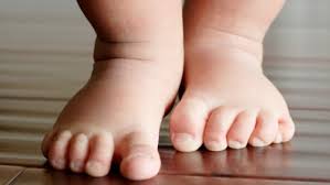 Способ лечения врожденной косолапости у детей Способ лечения врожденной косолапости у детей