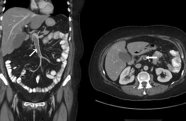 Тромбоз брыжеечных вен: симптомы, причины, диагностика, лечение