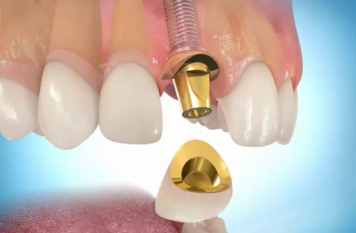 Дентальная имплантация – прорыв в области стоматологии