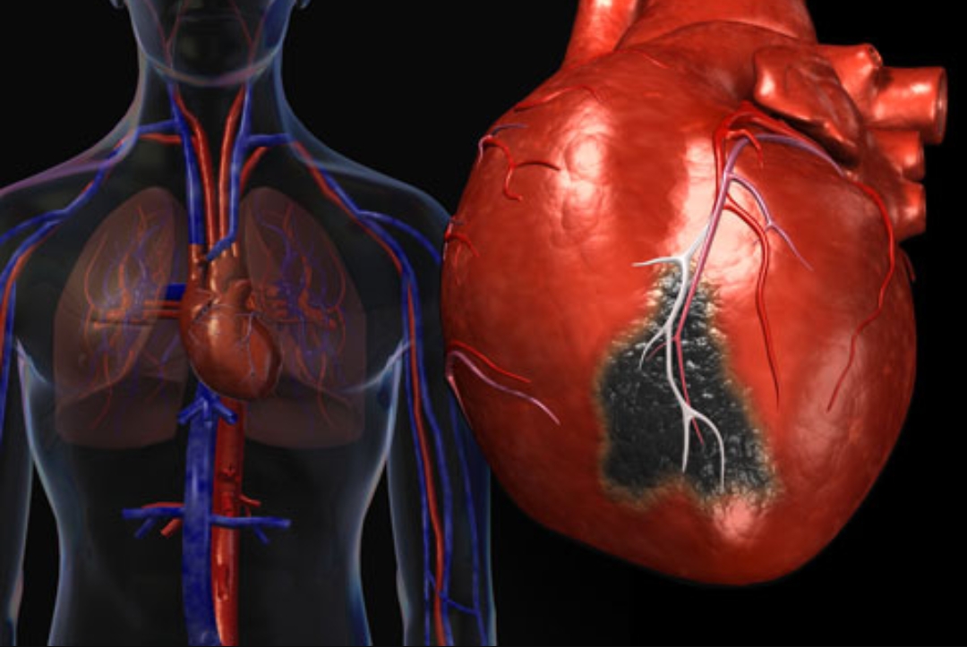 Инфаркт миокарда: основные принципы профилактики