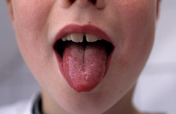 Чем опасна скарлатина и как ее лечить