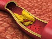 Хроническое воспаление десен ведет к атеросклерозу