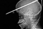 Американские хирурги успешно извлекли 90-сантиметровый гарпун из черепа подростка
