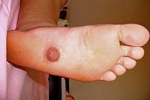 Врачи выявили первый случай наличия соска на подошве ноги
