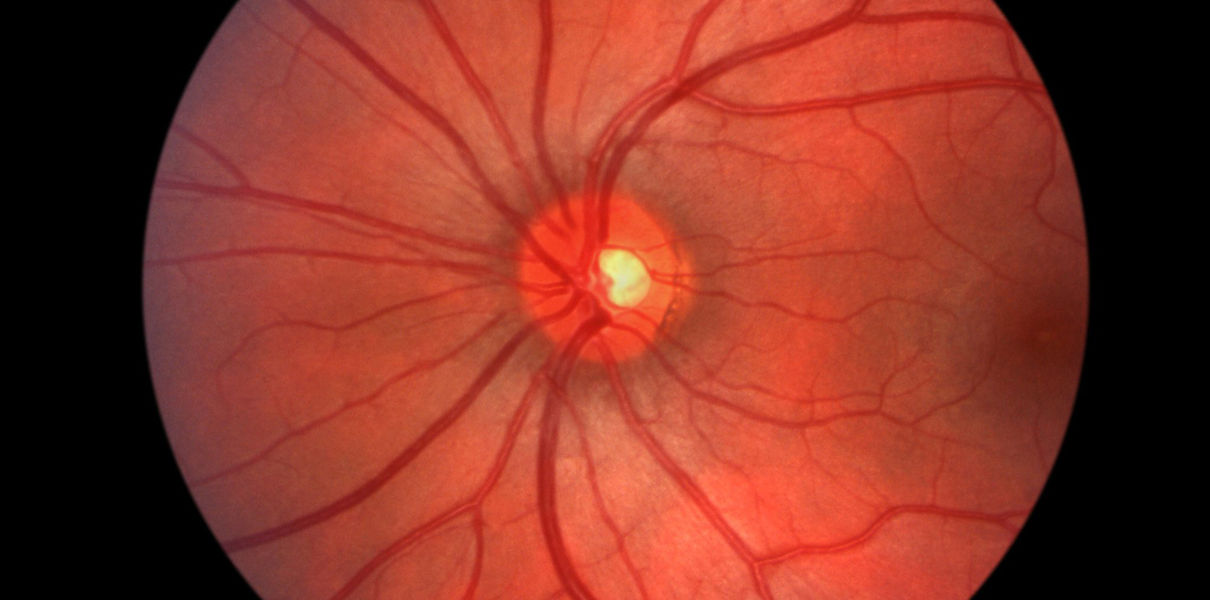 Создан ИИ, диагностирующий болезни глаз быстрее врачей