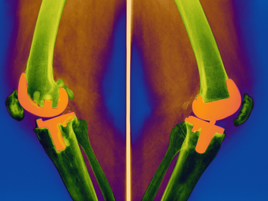 Биосовместимые имплантаты мягких тканей созданы в Перми 