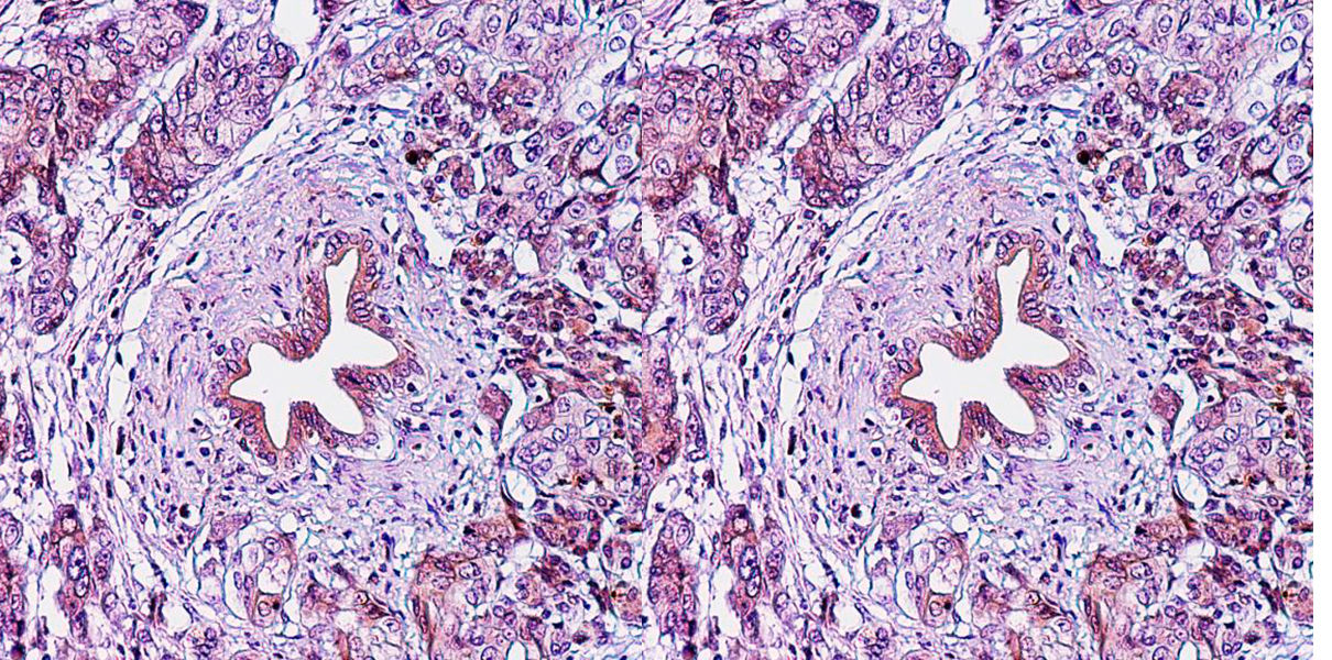 Разработан метод ранней диагностики рака поджелудочной железы