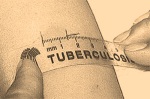 Разработан новый способ быстрой и точной диагностики туберкулеза