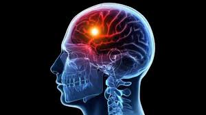 12 симптомов того, что произошел микроинсульт