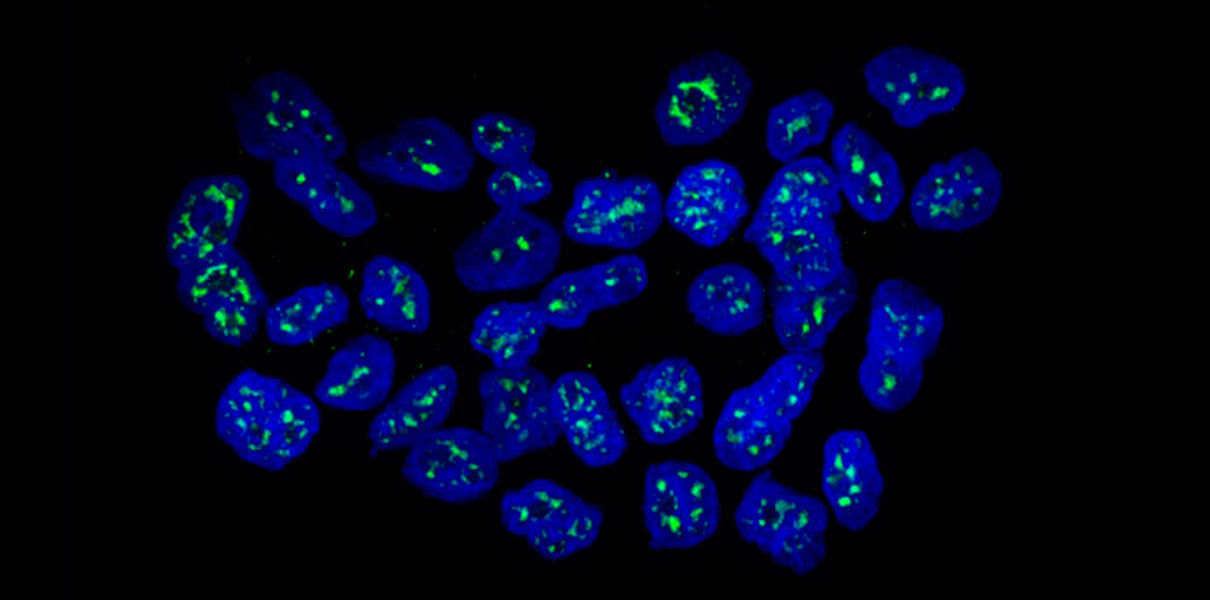 Найден способ остановки распространения раковой опухоли Найден способ остановки распространения раковой опухоли