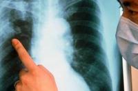 Подведены итоги противотуберкулезных мероприятий в Узбекистане Подведены итоги противотуберкулезных мероприятий в Узбекистане