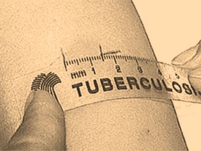 туберкулёз 2.jpg